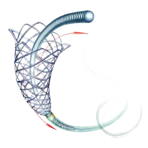 Self-Expandable Braided Stent